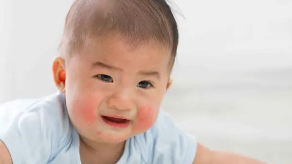 Kenali Lebih Dalam Penyebab Eksim pada Anak dan Pengobatannya