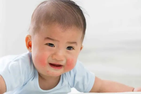 Kenali Lebih Dalam Penyebab Eksim pada Anak dan Pengobatannya